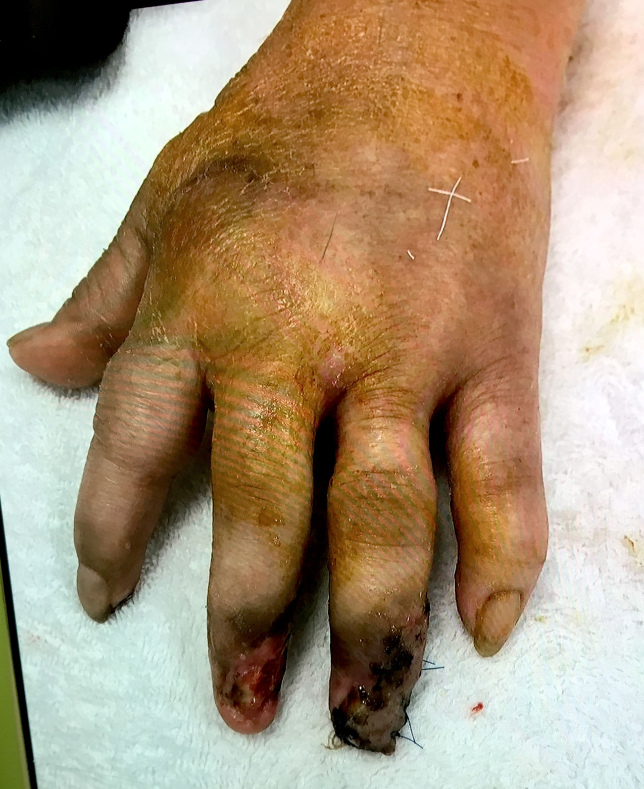 Meatpacking injuries